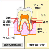 歯周病の要因と進行図