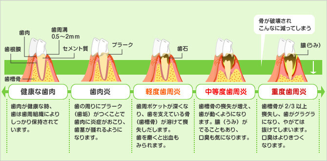歯周病の進行図