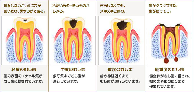 むし歯の進行と症状図