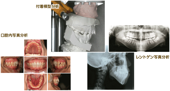 口腔内写真分析 付着模型分析 レントゲン写真分析